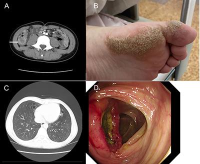 A novel splice donor mutation in DCLRE1C caused atypical severe combined immunodeficiency in a patient with colon lymphoma: case report and literature review